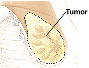 Cutaway view of breast with tumor