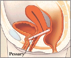 Image of pessary inserted